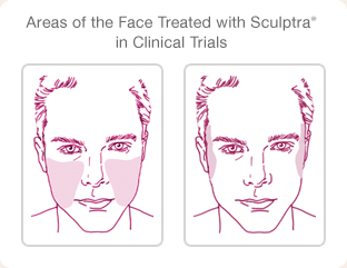 SCULPTRA.ZONES.OF.INJECTION